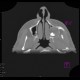 Follicular cyst in the maxillary sinus: CT - Computed tomography